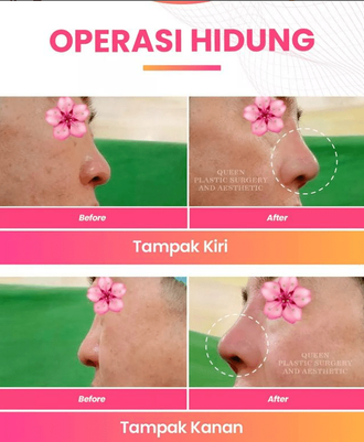 Hasil Rhinoplasty Queen Plastic Surgery, foto 76