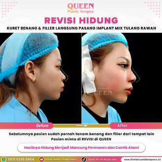 Hasil Rhinoplasty Queen Plastic Surgery, foto 78