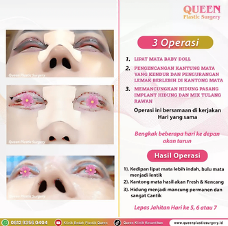 Hasil Rhinoplasty Queen Plastic Surgery, foto 66