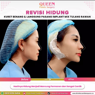 Hasil Rhinoplasty Queen Plastic Surgery, foto 64
