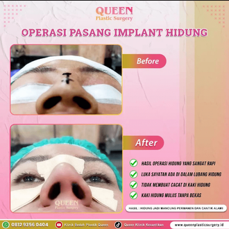 Hasil Rhinoplasty Queen Plastic Surgery, foto 65