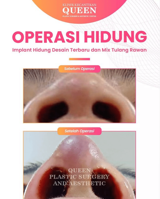 Hasil Rhinoplasty Queen Plastic Surgery, foto 63