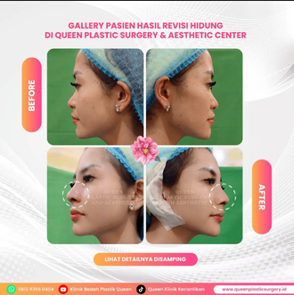 Hasil Rhinoplasty Queen Plastic Surgery, foto 62