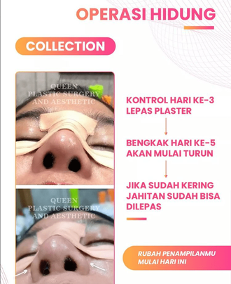 Hasil Rhinoplasty Queen Plastic Surgery, foto 61