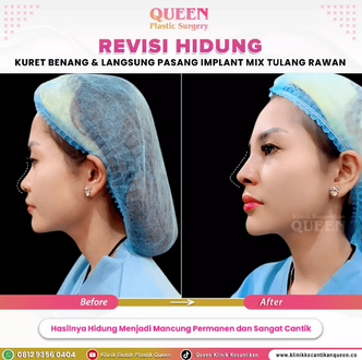 Hasil Rhinoplasty Queen Plastic Surgery, foto 60