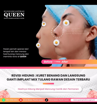 Hasil Rhinoplasty Queen Plastic Surgery, foto 59
