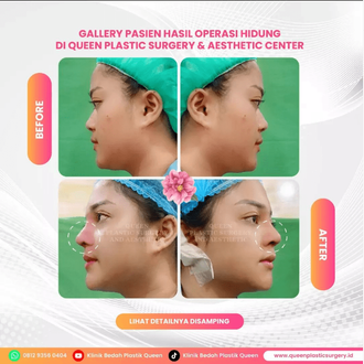 Hasil Rhinoplasty Queen Plastic Surgery, foto 58