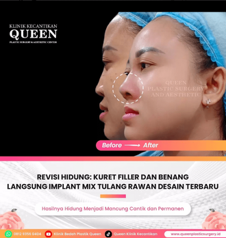Hasil Rhinoplasty Queen Plastic Surgery, foto 57