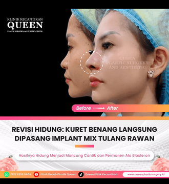 Hasil Rhinoplasty Queen Plastic Surgery, foto 56