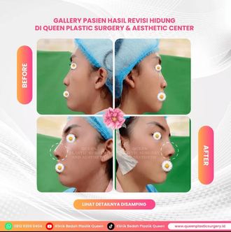 Hasil Rhinoplasty Queen Plastic Surgery, foto 55
