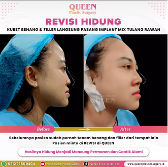 Hasil Rhinoplasty Queen Plastic Surgery, foto 43