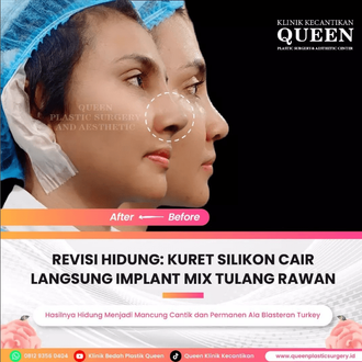 Hasil Rhinoplasty Queen Plastic Surgery, foto 44