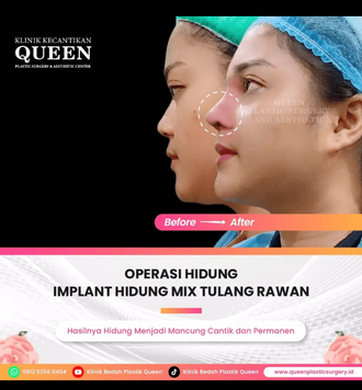 Hasil Rhinoplasty Queen Plastic Surgery, foto 45