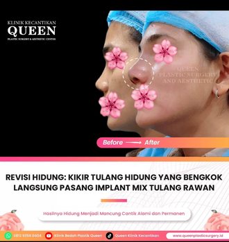 Hasil Rhinoplasty Queen Plastic Surgery, foto 46