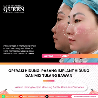 Hasil Rhinoplasty Queen Plastic Surgery, foto 47