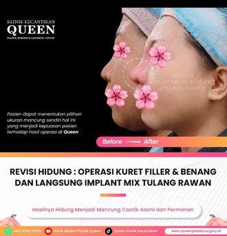 Hasil Rhinoplasty Queen Plastic Surgery, foto 48