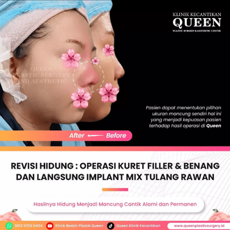 Hasil Rhinoplasty Queen Plastic Surgery, foto 49