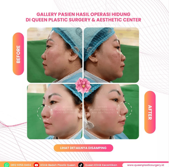 Hasil Rhinoplasty Queen Plastic Surgery, foto 50