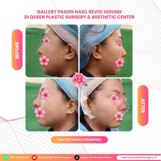 Hasil Rhinoplasty Queen Plastic Surgery, foto 51