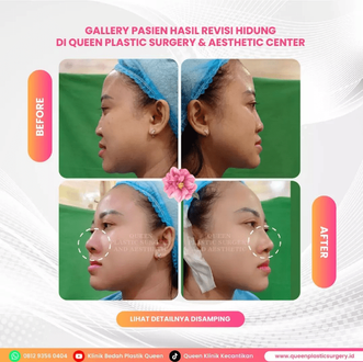 Hasil Rhinoplasty Queen Plastic Surgery, foto 52