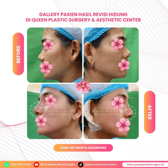 Hasil Rhinoplasty Queen Plastic Surgery, foto 53