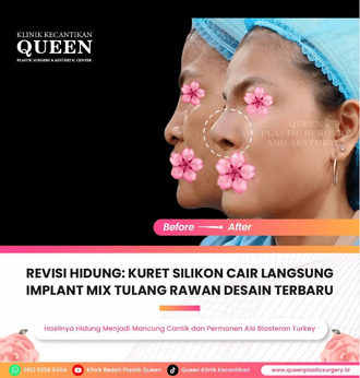 Hasil Rhinoplasty Queen Plastic Surgery, foto 54