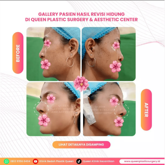 Hasil Rhinoplasty Queen Plastic Surgery, foto 42