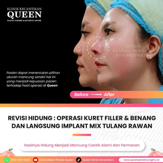 Hasil Rhinoplasty Queen Plastic Surgery, foto 40