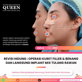 Hasil Rhinoplasty Queen Plastic Surgery, foto 39