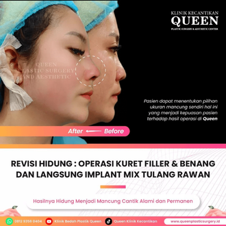 Hasil Rhinoplasty Queen Plastic Surgery, foto 38