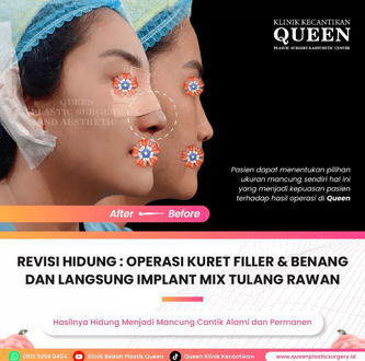 Hasil Rhinoplasty Queen Plastic Surgery, foto 37