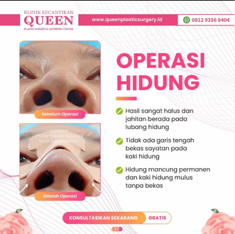 Hasil Rhinoplasty Queen Plastic Surgery, foto 35