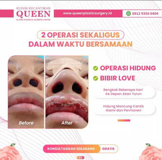 Hasil Rhinoplasty Queen Plastic Surgery, foto 34