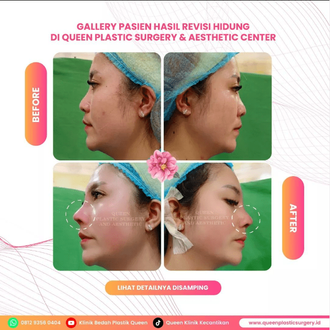 Hasil Rhinoplasty Queen Plastic Surgery, foto 33