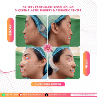 Hasil Rhinoplasty Queen Plastic Surgery, foto 32