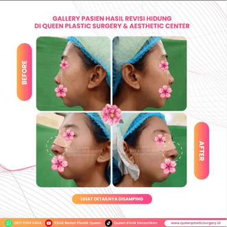 Hasil Rhinoplasty Queen Plastic Surgery, foto 31