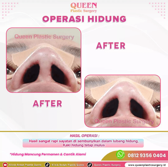 Hasil Rhinoplasty Queen Plastic Surgery, foto 19