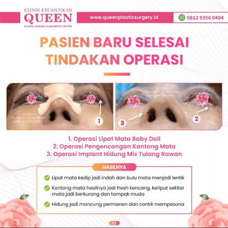 Hasil Rhinoplasty Queen Plastic Surgery, foto 20