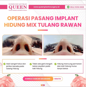 Hasil Rhinoplasty Queen Plastic Surgery, foto 21