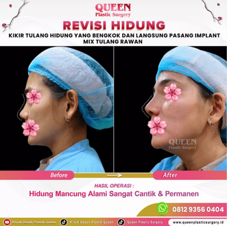 Hasil Rhinoplasty Queen Plastic Surgery, foto 22