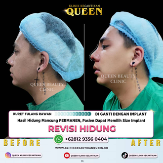 Hasil Rhinoplasty Queen Plastic Surgery, foto 23