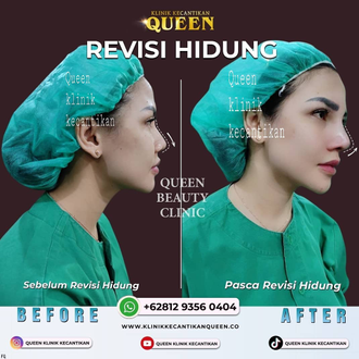 Hasil Rhinoplasty Queen Plastic Surgery, foto 24