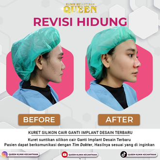 Hasil Rhinoplasty Queen Plastic Surgery, foto 26