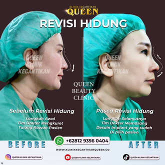 Hasil Rhinoplasty Queen Plastic Surgery, foto 27