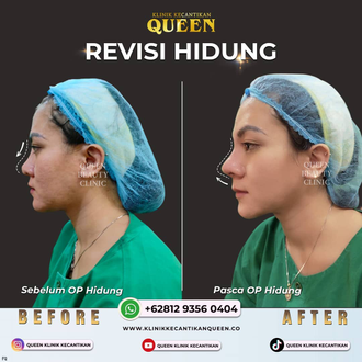 Hasil Rhinoplasty Queen Plastic Surgery, foto 28