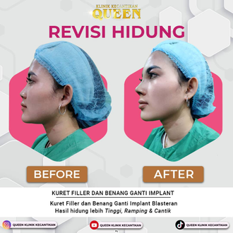 Hasil Rhinoplasty Queen Plastic Surgery, foto 29