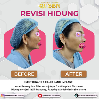 Hasil Rhinoplasty Queen Plastic Surgery, foto 30