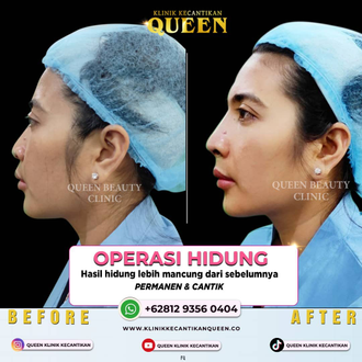 Hasil Rhinoplasty Queen Plastic Surgery, foto 18