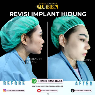 Hasil Rhinoplasty Queen Plastic Surgery, foto 17