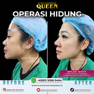 Hasil Rhinoplasty Queen Plastic Surgery, foto 16